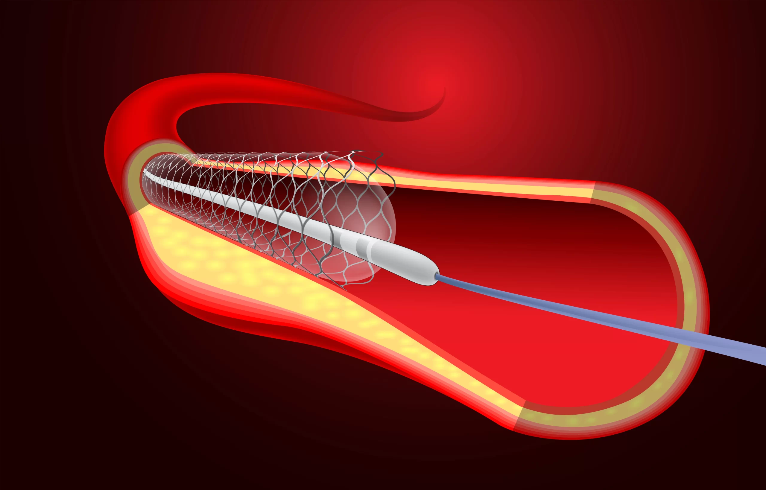 Cirurgia Vascular