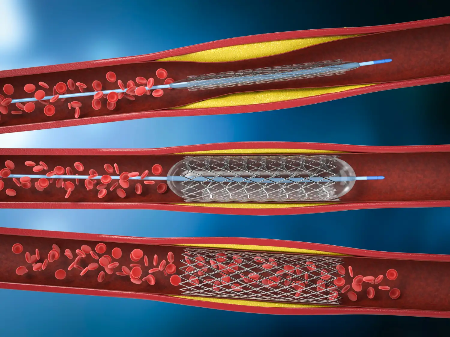 Angioplastia